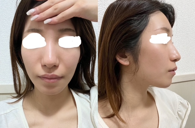 鼻整形前のビフォー写真。”団子鼻”で鼻先の丸みが気になっていた